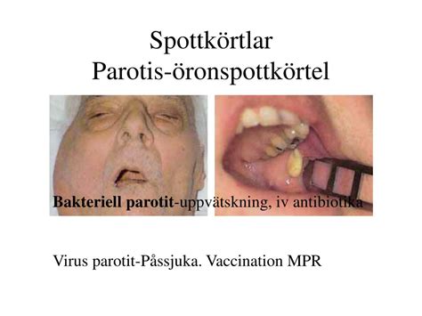 Öronspottkörtel knöl